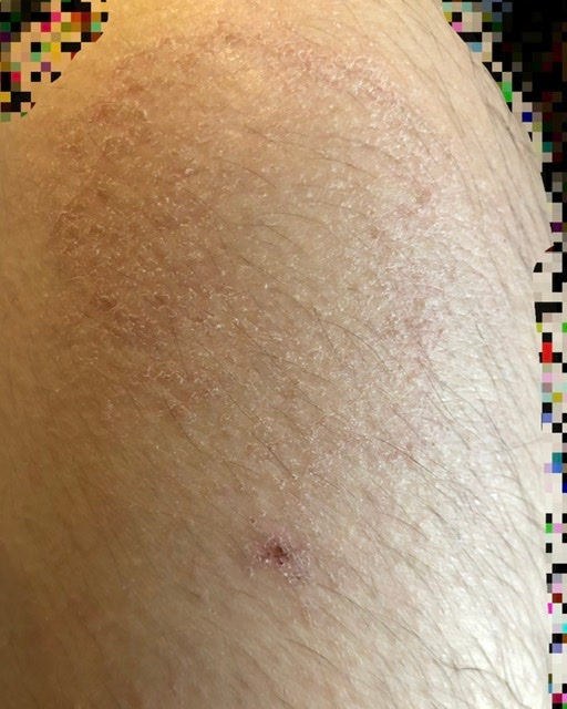 梅毒について質問します 画像の膝のように 皮膚がカサカサしています Yahoo 知恵袋