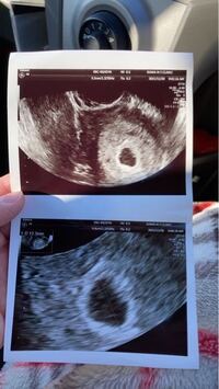 6w0dのエコーです 今日心拍が確認できるかと思ったら 確認 Yahoo 知恵袋