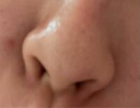 美容整形詳しい方にお聞きしたいです。 この鼻はどんな整形をすれば治りますか？