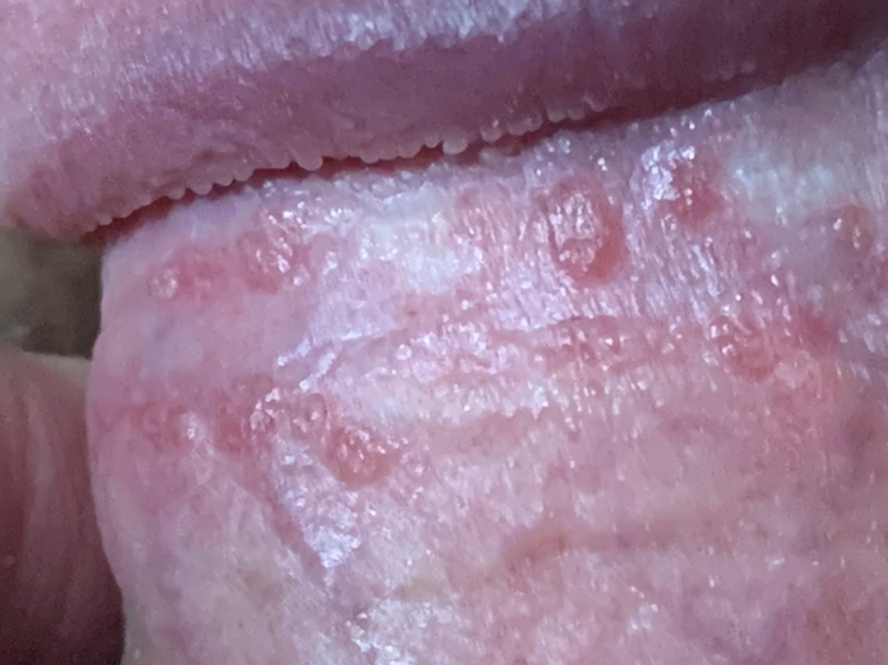 閲覧注意お見苦しいものをお見せして申し訳ございません 僕のカリの下あたりの竿 Yahoo 知恵袋