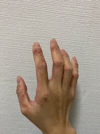 この手荒れは市販の薬では治らないですか 今はお医者さんから処 Yahoo 知恵袋