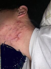 首ににきびなのかとんでもなく出来物ができて辛いんですけどこれはなんなのでしょ Yahoo 知恵袋