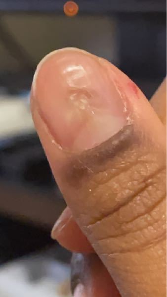 9月頃に甘皮用のプッシャーで勢い余って爪がこんなふうになっちゃいました。この状態から爪は新たに生えてくると思いますか？また、生え変わるなら何ヶ月ほどかかると思いますか？ 病院行った方がいいですかね？