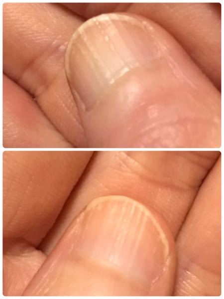 ちょっと写真では分かりにくいのですが、親指の爪の縦線がすごいのですが、これは身体のどこの不調とかあるんでしょうか？ 親指以外の他の指も全てうっすら縦線があるのですが、親指の爪が一番縦線がすごいです。