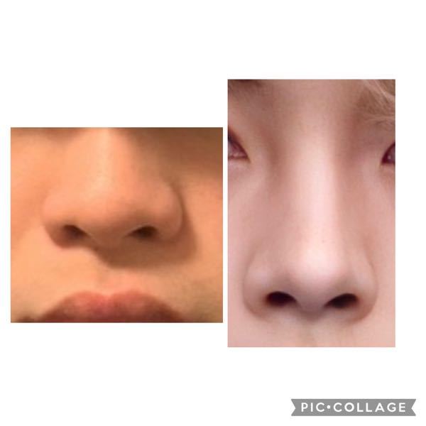 鼻の整形したいんですが、左から右の鼻に鼻尖形成と鼻翼縮小すればなれるんでしょうか？