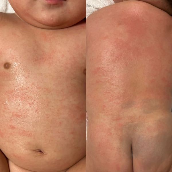 生後６ヶ月です。ここ最近、お風呂上がりにお腹と背中に赤みが出ます。日中はこんなに赤み出てませんが、少し荒れている感じです。こまめに保湿していますが中々治りません。乳児湿疹か汗疹でしょうか？
