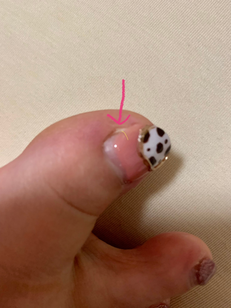 ジェルネイルしている足の爪が割れてしまいました 画像の矢印の部分に Yahoo 知恵袋