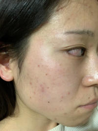 閲覧注意 産後1年は肌荒れの心配なく過ごしてきたのですが ここ最 Yahoo 知恵袋