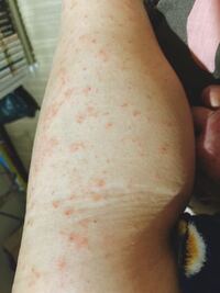 汚い足の画像を載せてます 2 3日前から急に手足が痒くなり赤いぶつぶ Yahoo 知恵袋