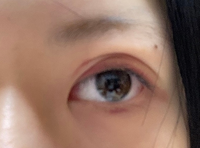 埋没ダウンタイム１日目なんですけど、左はとっても綺麗なのに右目がこうなっていて不安です。。綺麗になりますか？ 