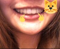 ワイヤー矯正が終わりリテーナー生活3年ほど経ちました 気づいたら Yahoo 知恵袋