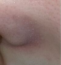 小鼻の角栓について 汚い写真ですみません 上手く撮れなくて見づらいです Yahoo 知恵袋