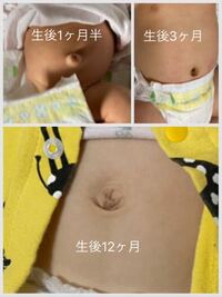 子どものおへそについて 1歳0ヶ月の息子のおへそがでべそになってきたので Yahoo 知恵袋