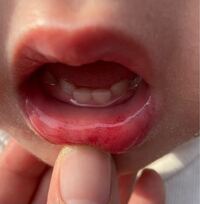 2歳の子供が気づいたら唇の下の部分が赤くなってました 本人は痛がる様子 Yahoo 知恵袋