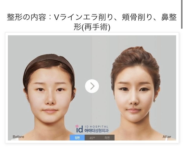 このビフォーアフターって本当だと思いますか エラ 頬骨削りでこれだけ顔は細く Yahoo 知恵袋