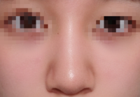 団子鼻の治し方 団子鼻の解消方法を知りたいです
肌が汚くてすみません
至急です
