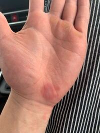 昨日の夜から手にあざができました 痛くも痒くもないのですが今日右手 Yahoo 知恵袋