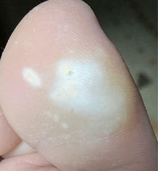 今日家に帰って風呂に入った後に足を見たら、片足の親指だけこんな感じに白くなっていました。 これって水虫なのでしょうか。 かゆみや他に変なところはありません。