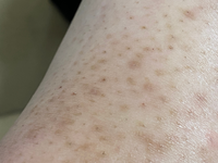 至急 足の毛穴の黒ずみ 色素沈着がなかなかなおりません何を塗ったりしたら Yahoo 知恵袋