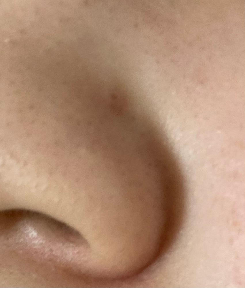 少し恥ずかしいですが、私の鼻の写真です、、、 鼻の横に赤くなっている毛穴と、鼻全体に毛穴が目立ちます、、、 どうすれば毛穴フリーの鼻になれますか？