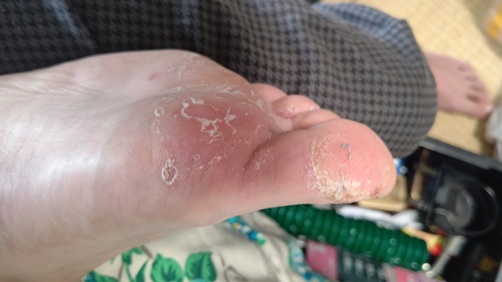 水虫 解決済みの質問 Yahoo 知恵袋