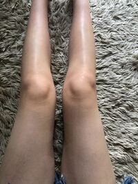 足の膝の内側の骨が出てるのがコンプレックスです。細くなってもキレイな形になりません。 歩き方や、くせをつけたら治りますか？X字というやつですか？