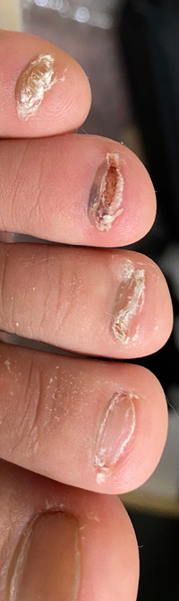 爪をむしる癖は直すことはできますか 台前半の女です 物心つい Yahoo 知恵袋