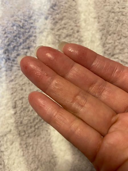 何年も指の第一関節から第二関節までの指が手荒れしていていくら保湿クリームをしてもステロイドを塗っても良くなりません。 手をギュッと握ることもしにくくなるくらい皮膚が薄いのか握りづらいです。 プツ...