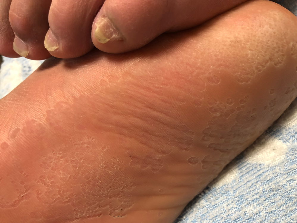【閲覧注意】 足の裏がこのように皮がめくれています。 指の間も同様のめくれか起きています。 痒みなどはありません。 これは水虫でしょうか？？ また違う病気なら教えてください