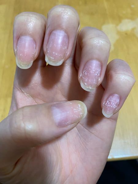 爪にこのような白い斑点が、日に日に増えています。 何かの病気でしょうか？ また、どういった科を受診すべきでしょうか？ 経験のある方、詳しい方、ご回答お待ちしております。