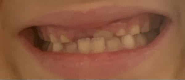 反対咬合の矯正経験のある方、または歯科に関して詳しい方の回答が希望です。 7歳 小学２年生です。 歯科で反対咬合だと言われ、矯正歯科を数件紹介してもらいました。 色々調べていると、ムーシールド...