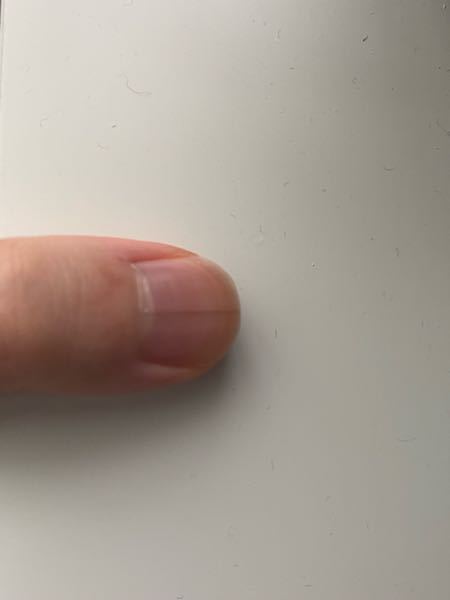 高校2年生です（関係あるかな？） 爪に縦線があります。 これを治せる方法ってありますか？ あと害ってありますか？
