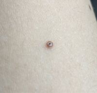 高2女子です 最近 ほくろがかさぶたになって取れそうです ほくろを取っ Yahoo 知恵袋