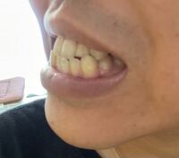 歯列矯正に関してです 私は写真の通りシャクレなのですが これ Yahoo 知恵袋