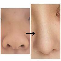 左の鼻を右の鼻にするにはどんな整形をすれば良いですか？ 