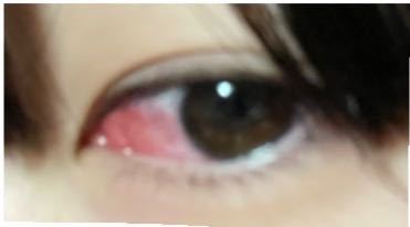中2女子です。 1週間前くらいにめちゃくちゃ目が痒くなって目が真 っ赤でした。（写真は自分の目です） 一昨日眼科にいったら、花粉かエアコンのなんかのア レルギーと言われました。 目薬をも...