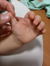 指しゃぶりで 手荒れしてます 1才の子なんですが 眠い時等に左手の Yahoo 知恵袋