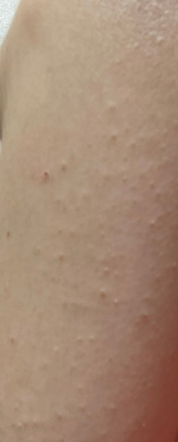 画像閲覧注意です 高2女子です 中学の時から腕の外側のぶつぶつに悩んでいます Yahoo 知恵袋