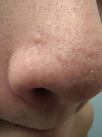 鼻がやばいです メイクをする前から黒ずみや角栓はありますが Yahoo 知恵袋