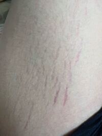 これって肉割れですか 太ももの付け根です Yahoo 知恵袋