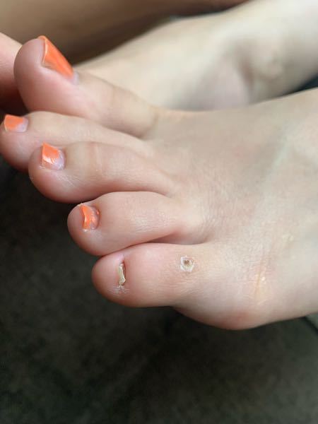 足の小指の爪がこの様に埋もれてるのですが病院に行くべきでしょうか？？ 周りの人からは歩き方がおかしいと言われる事もあります、、、 痛みなどはありません。