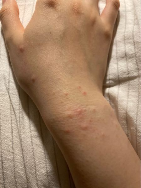 手首と手の甲にこの様な赤いブツブツが出来て徐々に広がってきています。微妙に痒みがあります。また指の腹にブツブツではなく水泡のような物まででき始めました…。これは手湿疹ですか？皮膚科に行くべきでし...