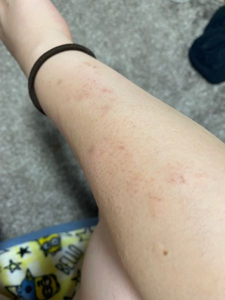 ココ最近腕の痒みが酷いです。 ブツブツのでこぼこな感じです。 アレルギーなのか、蕁麻疹なのか分かりません。 休みの時に病院に行ってみます。 わかる方よろしくお願いします。