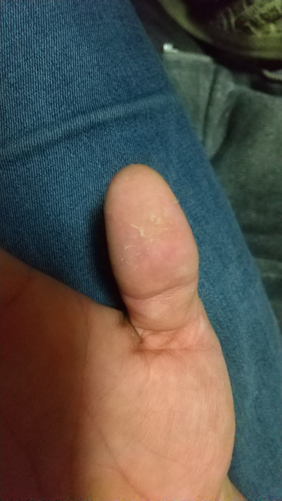 右手の親指の皮むけについて 数日前から親指の腹が皮むけてまして、色々調べると水虫やら汗疱やら色々出てくる。 もちろん皮膚科に行くのが一番だとは分かってはいますがなるべく病院に行かずに治したいと...
