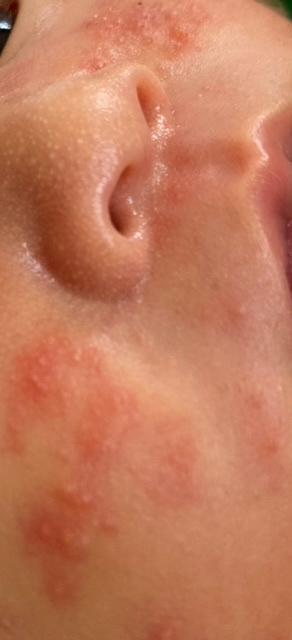 子どもの病気とトラブル すべての質問 Yahoo 知恵袋