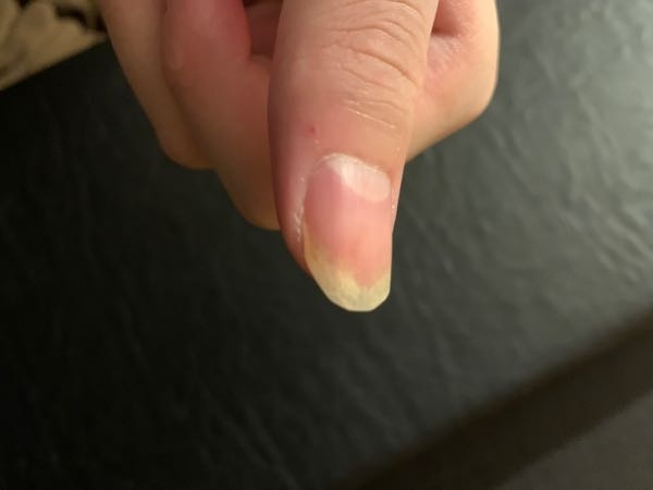 手の爪水虫なのでしょうか？ 1年ほど前から手の爪が白く濁って？います？ 左手親指の爪だけだったし、なんだろ？と思いながらも長らく放置していて気がつけば両の手のいくつかの爪も同じようになっています。 最