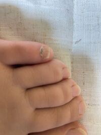 足の小指の爪にだけ黒い線のようなものがあります 汚れかなと思 Yahoo 知恵袋