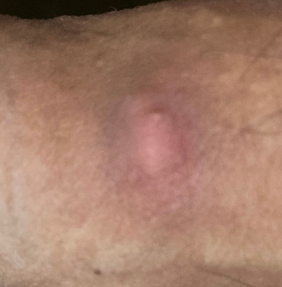 ペニスの包皮にニキビ用なものができました 押したら少し痛い感じ5日前にパート Yahoo 知恵袋