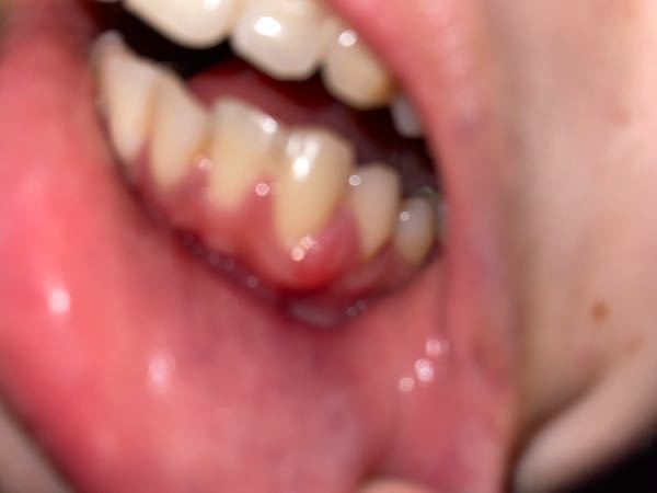 歯茎の腫れについて ご飯を食べていたら歯茎が腫れている感覚がして見てみるとポコッと腫れています。 かちかち噛むと痛みと言うより麻酔の時のような違和感があります。 歯周病か何かでしょうか…？？ 初...
