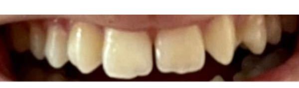 歯の数が少なくてすきっ歯だし歯の形が汚くて治したいと思ってます。綺麗にするにはどんな治療で費用はどのくらいかかりますか？
